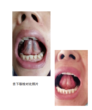 无痛舌下取栓疗法3.PNG